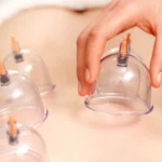 Czy bańki chińskie pomagają na cellulit?