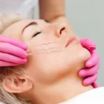 Nici liftingujące – Czy można wykonać zabieg z użyciem nici liftingujących?