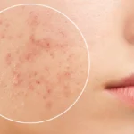 Trądzik pospolity – pozbądź się problemu raz na zawsze!